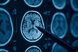 Physiotherapie Schlaganfall