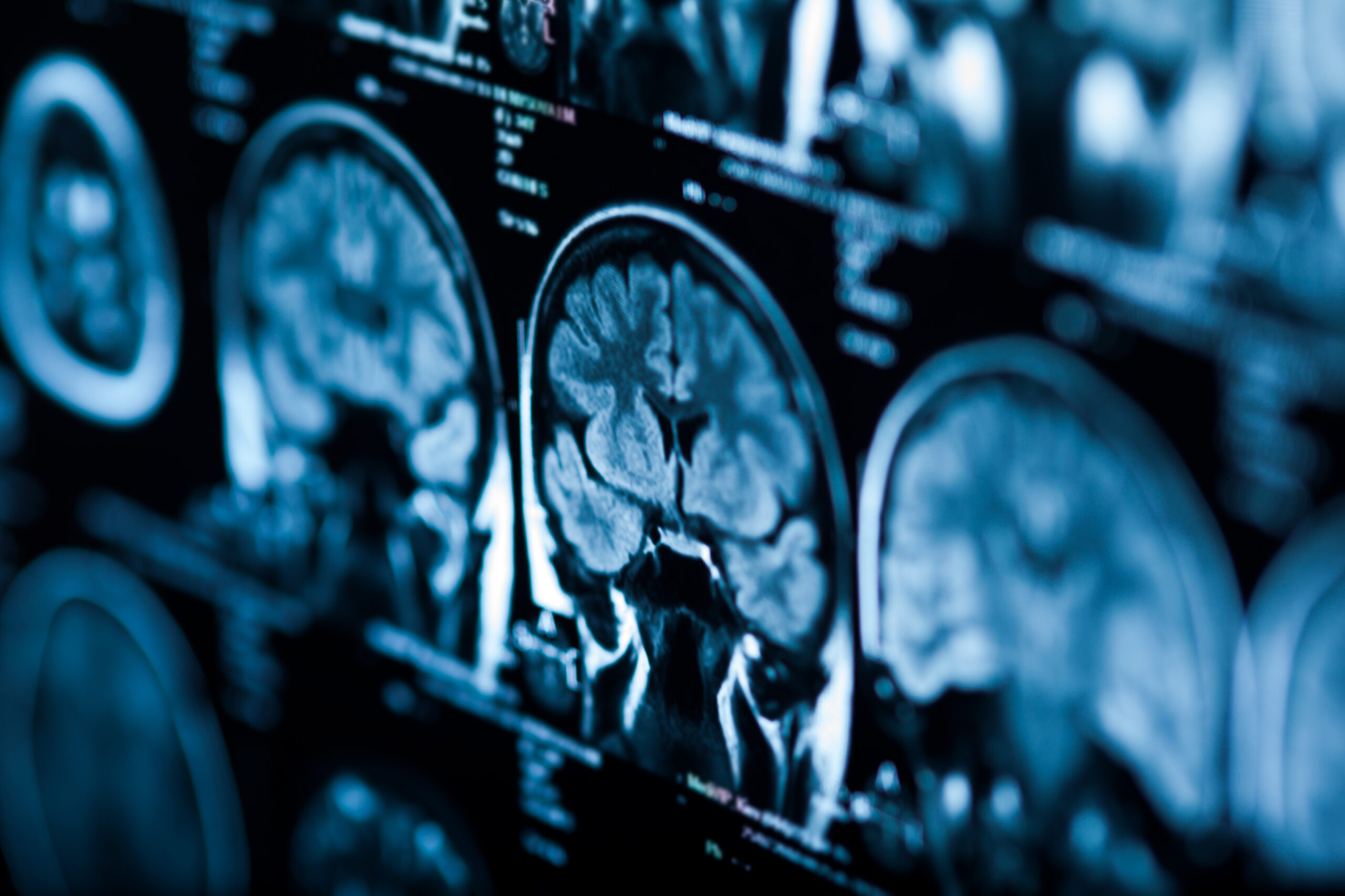 Physiotherapie bei neurologischen Erkrankungen